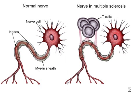 MS nerve cells versus normal cells